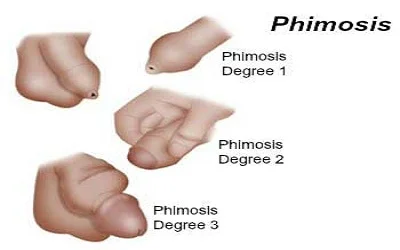 The Management of Phimosis Seen after Circumcision with Thermocautery.